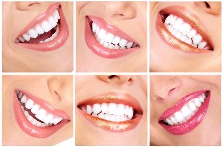 Teeth Whitening: Which option is right for YOU…?